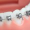 Ortodontia com Bráquetes Autoligáveis